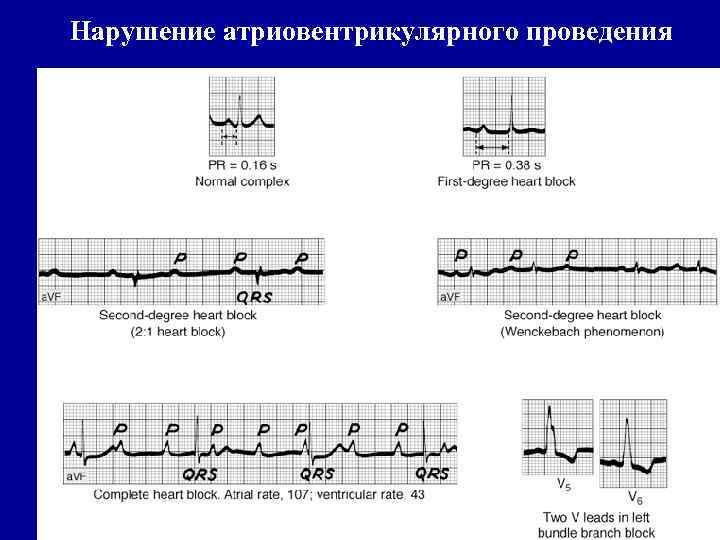 Нарушение атриовентрикулярного проведения 