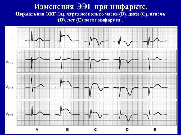 Изменения ЭЭГ при инфаркте. Нормальная ЭКГ (А), через несколько часов (В), дней (С), недель