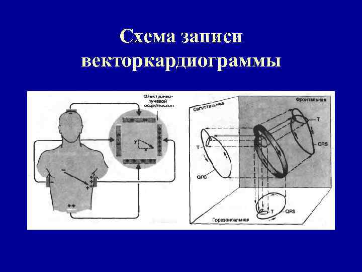 Схема записи векторкардиограммы 