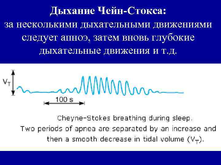 Дыхание Чейн-Стокса: за несколькими дыхательными движениями следует апноэ, затем вновь глубокие дыхательные движения и