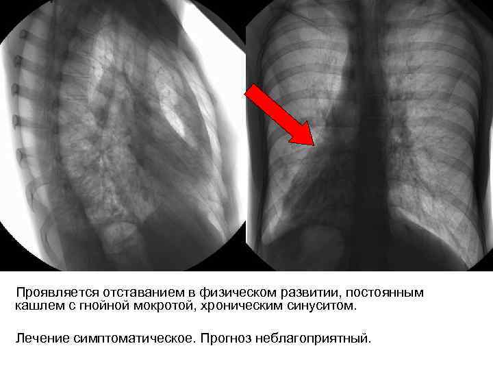 Проявляется отставанием в физическом развитии, постоянным кашлем с гнойной мокротой, хроническим синуситом. Лечение симптоматическое.