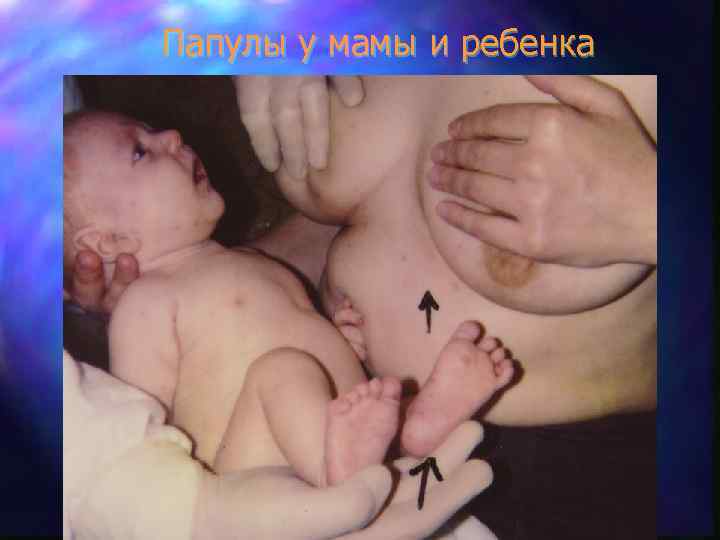 Папулы у мамы и ребенка 