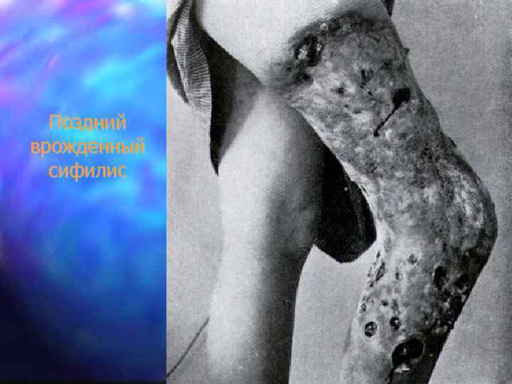Поздний врожденный сифилис 