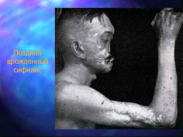 Поздний врожденный сифилис 