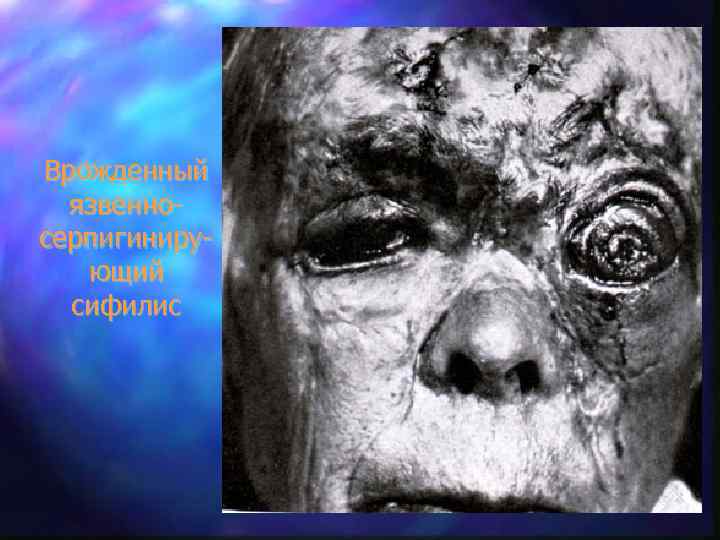 Врожденный язвенносерпигинирующий сифилис 