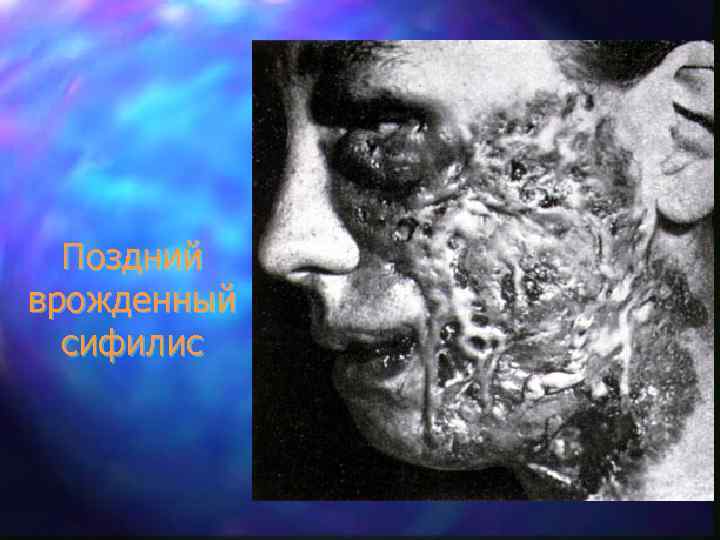 Поздний врожденный сифилис 