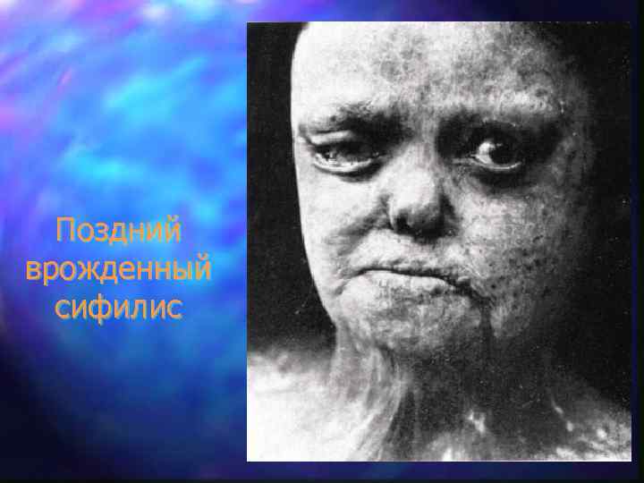 Поздний врожденный сифилис 