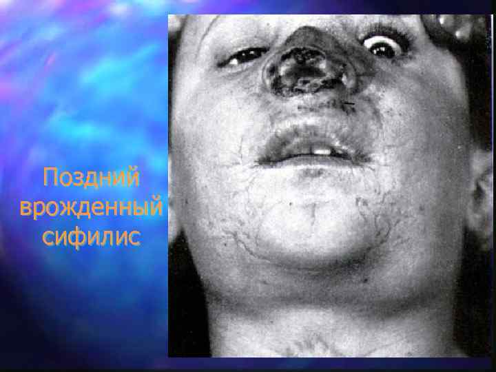 Поздний врожденный сифилис 