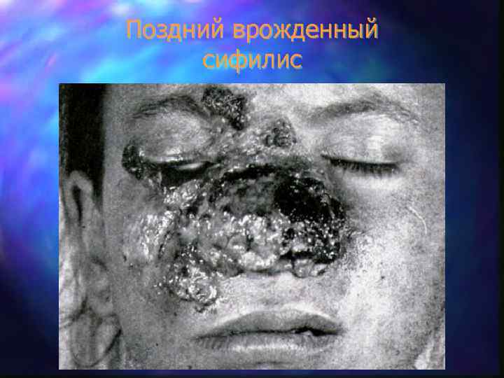 Поздний врожденный сифилис 