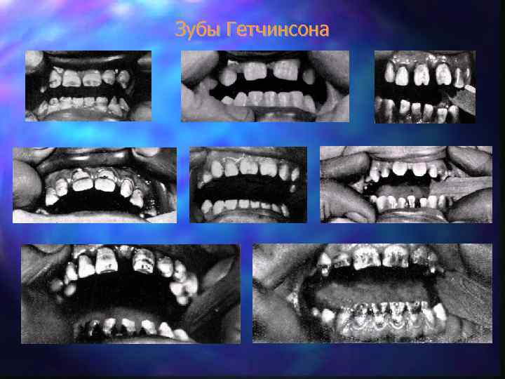 Зубы Гетчинсона 