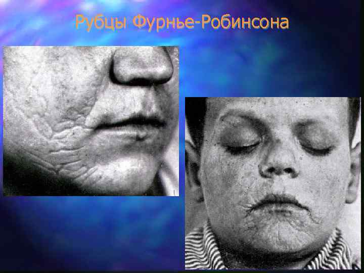 Рубцы Фурнье-Робинсона 