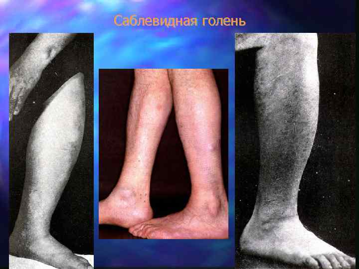 Саблевидная голень 