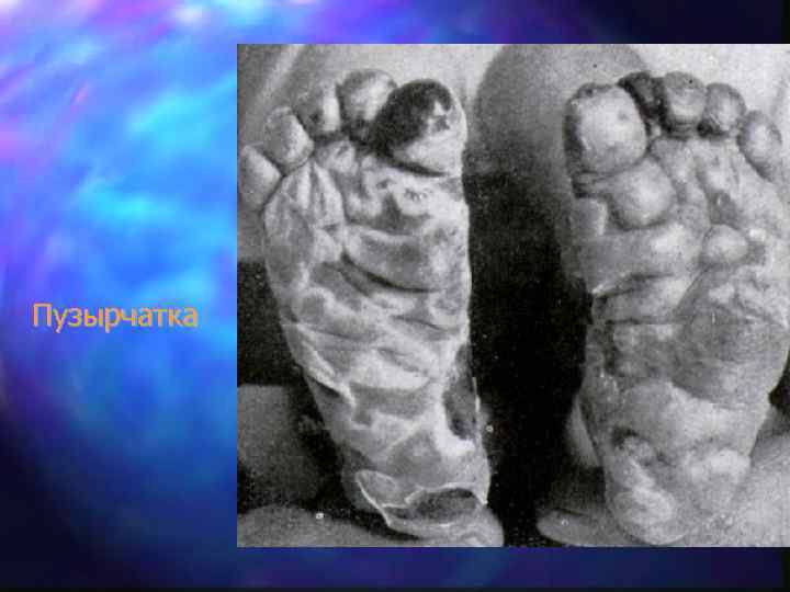 Пузырчатка 