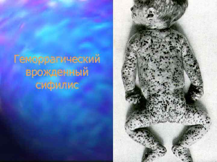 Геморрагический врожденный сифилис 