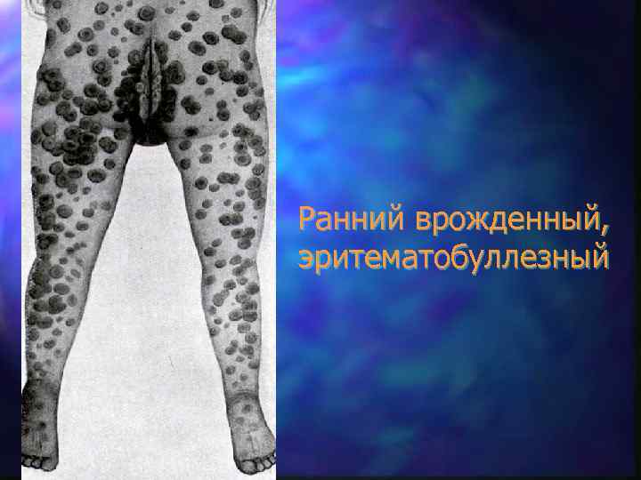 Ранний врожденный, эритематобуллезный 