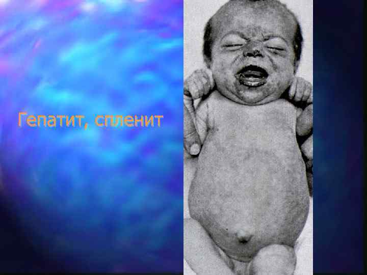Гепатит, спленит 