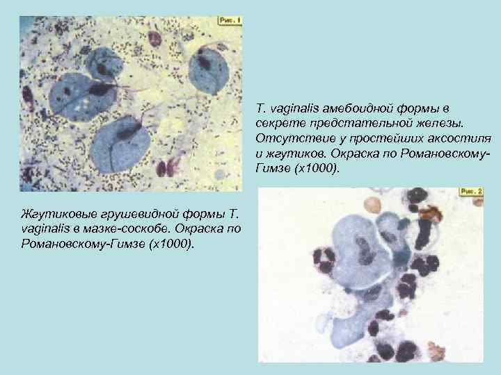 Т. vaginalis амебоидной формы в секрете предстательной железы. Отсутствие у простейших аксостиля и жгутиков.