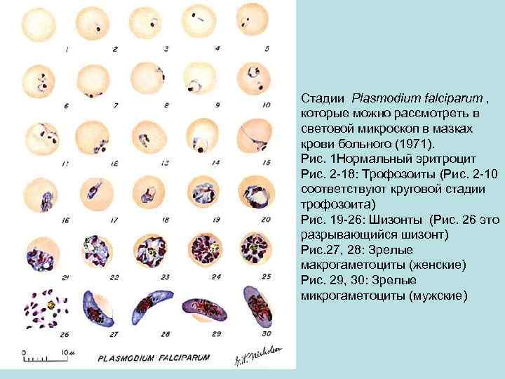 Стадии Plasmodium falciparum , которые можно рассмотреть в световой микроскоп в мазках крови больного