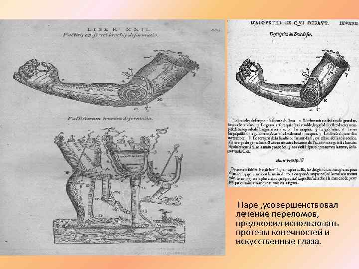  • Паре , усовершенствовал лечение переломов, предложил использовать протезы конечностей и искусственные глаза.