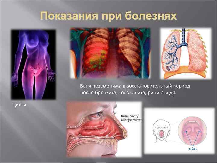 Показания при болезнях Баня незаменима в восстановительный период после бронхита, тонзиллита, ринита и др.