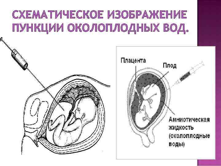 Околоплодная беременность. Пункция околоплодных вод. Прокол околоплодных вод. Взятие для исследования околоплодной жидкости это. Прокол околоплодного пузыря на анализ.