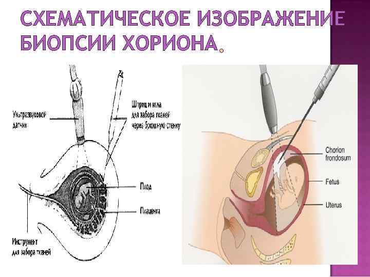 СХЕМАТИЧЕСКОЕ ИЗОБРАЖЕНИЕ БИОПСИИ ХОРИОНА 