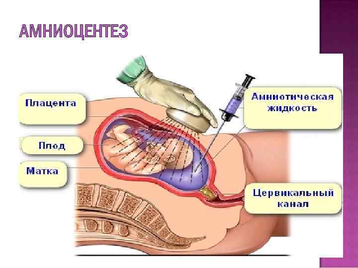 АМНИОЦЕНТЕЗ 