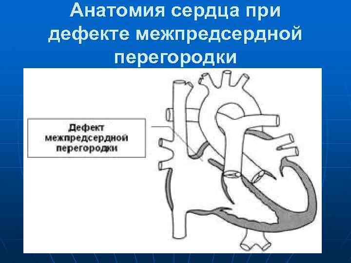 Анатомия сердца при дефекте межпредсердной перегородки 