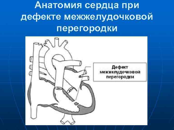 Анатомия сердца при дефекте межжелудочковой перегородки 