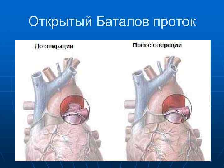 Открытый аортальный проток схема