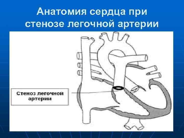 Анатомия сердца при стенозе легочной артерии 