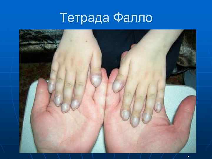 Тетрада Фалло n 