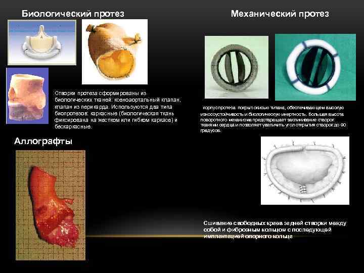 Биологический протез Створки протеза сформированы из биологических тканей: ксеноаортальный клапан, клапан из перикарда. Используются