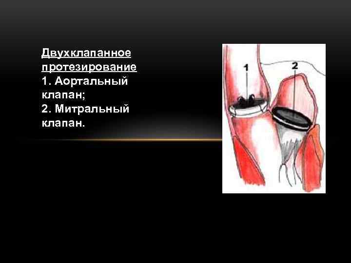 Двухклапанное протезирование 1. Аортальный клапан; 2. Митральный клапан. 