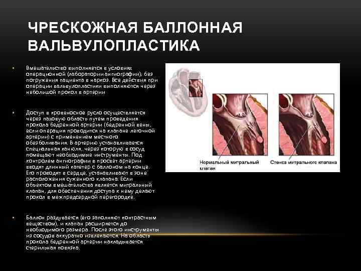 ЧРЕСКОЖНАЯ БАЛЛОННАЯ ВАЛЬВУЛОПЛАСТИКА • Вмешательство выполняется в условиях операционной (лаборатории ангиографии), без погружения пациента