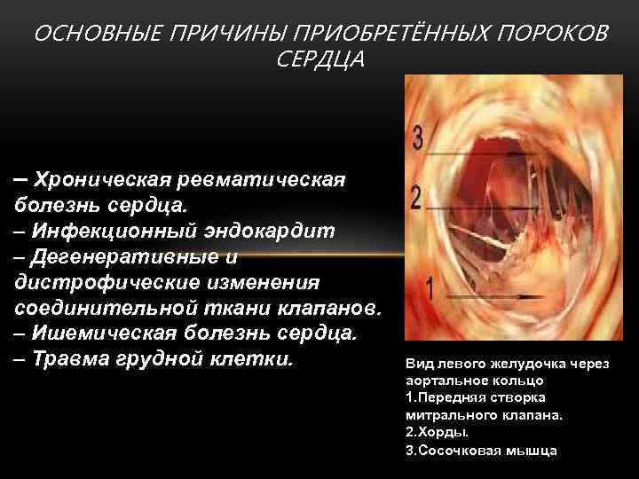 ОСНОВНЫЕ ПРИЧИНЫ ПРИОБРЕТЁННЫХ ПОРОКОВ СЕРДЦА – Хроническая ревматическая болезнь сердца. – Инфекционный эндокардит –