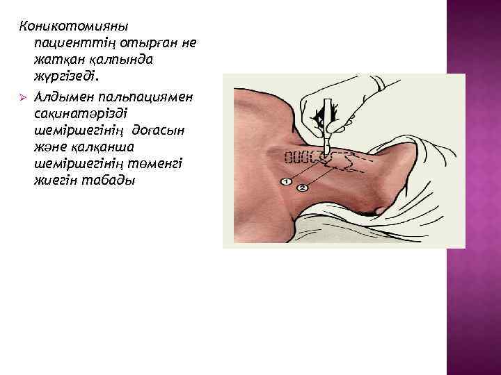 Коникотомияны пациенттің отырған не жатқан қалпында жүргізеді. Ø Алдымен пальпациямен сақинатәрізді шеміршегінің доғасын және
