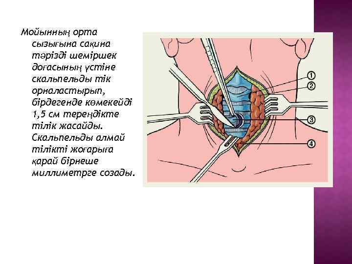 Мойынның орта сызығына сақина тәрізді шеміршек доғасының үстіне скальпельды тік орналастырып, бірдегенде көмекейді 1,