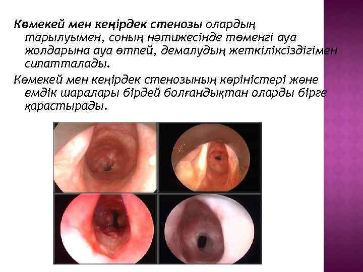 Көмекей мен кеңірдек стенозы олардың тарылуымен, соның нәтижесінде төменгі ауа жолдарына ауа өтпей, демалудың