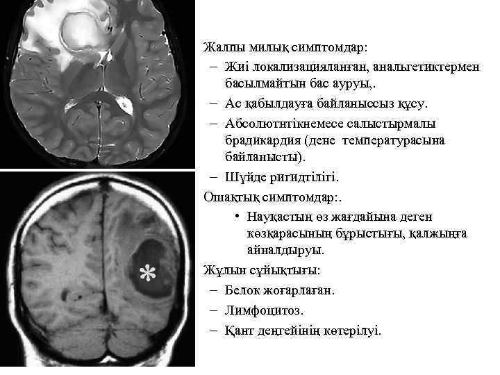  • Жалпы милық симптомдар: – Жиі локализацияланған, анальгетиктермен басылмайтын бас ауруы, . –