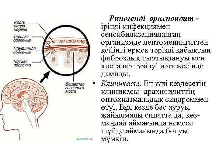  Риногенді арахноидит - іріңді инфекциямен сенсибилизацияланған организмде лептоменингиттен кейінгі өрмек тәрізді қабықтың фиброздық