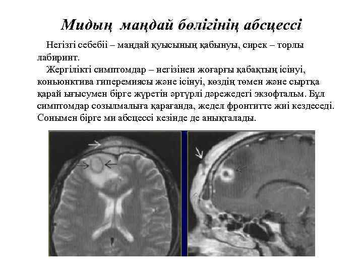 Мидың маңдай бөлігінің абсцессі Негізгі себебіі – маңдай қуысының қабынуы, сирек – торлы лабиринт.