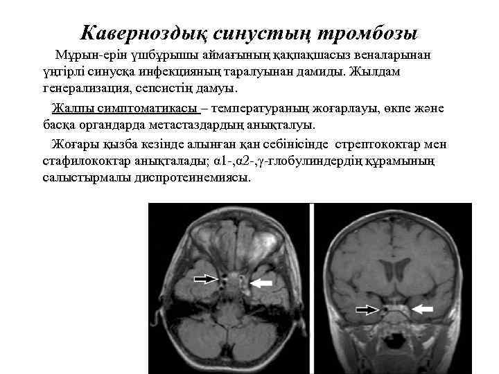 Каверноздық синустың тромбозы Мұрын ерін үшбұрышы аймағының қақпақшасыз веналарынан үңгірлі синусқа инфекцияның таралуынан дамиды.