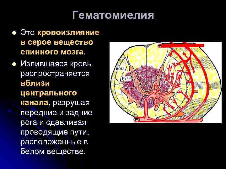 Гематомиелия l l Это кровоизлияние в серое вещество спинного мозга. Излившаяся кровь распространяется вблизи