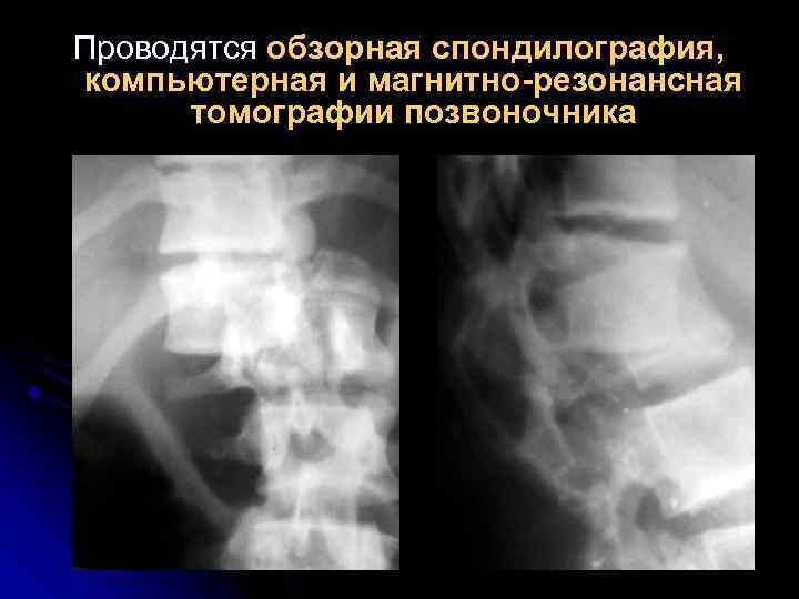 Проводятся обзорная спондилография, компьютерная и магнитно-резонансная томографии позвоночника 