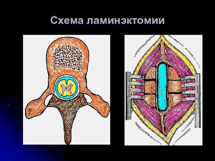 Схема ламинэктомии 