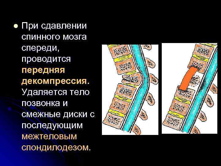 l При сдавлении спинного мозга спереди, проводится передняя декомпрессия. Удаляется тело позвонка и смежные