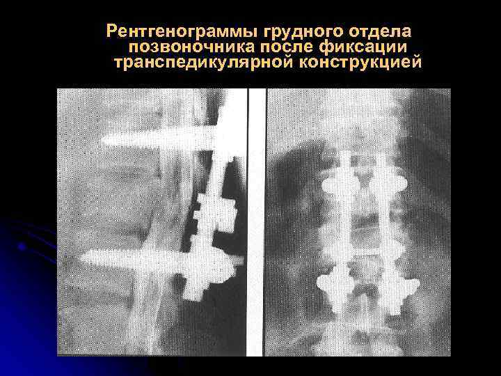 Рентгенограммы грудного отдела позвоночника после фиксации транспедикулярной конструкцией 