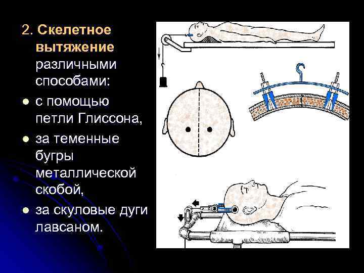 2. Скелетное вытяжение различными способами: l с помощью петли Глиссона, l за теменные бугры