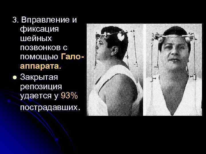 3. Вправление и фиксация шейных позвонков с помощью Галоаппарата. l Закрытая репозиция удается у